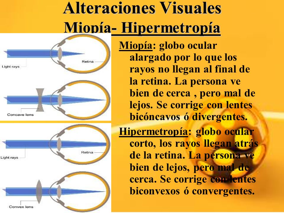 Hipermetropia lentes biconvexos new arrivals